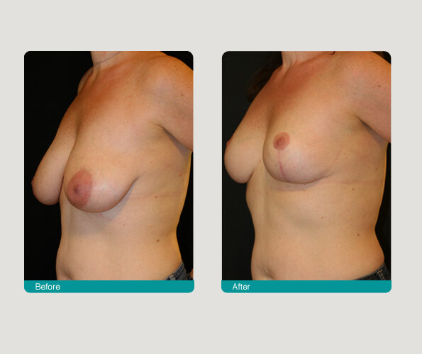 0146 5542 Breast Reduction
