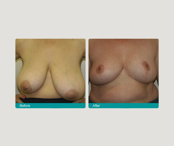 asym correction pane fv Breast Reduction