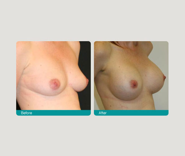 b aug by 1 Breast Reduction