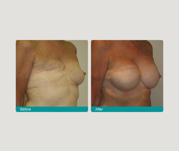 b reconstruction will ro Breast Reduction