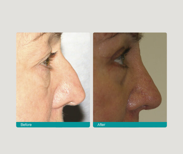 nose iver rs Rhinoplasty