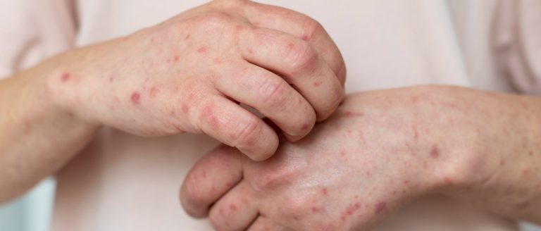 skin allergy person s arm Under your skin